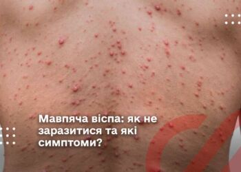 Мавпяча віспа: як не заразитися та які симптоми?